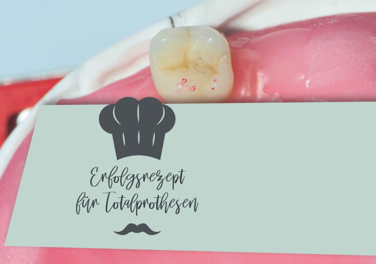 Erfolgsrezept für Totalprothesen