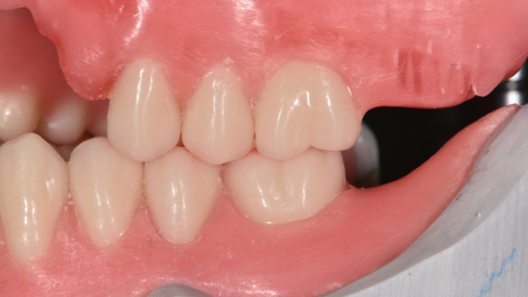 Aufstellung TiF – Zahn-zu-zwei-Zahn ohne Einschleifen