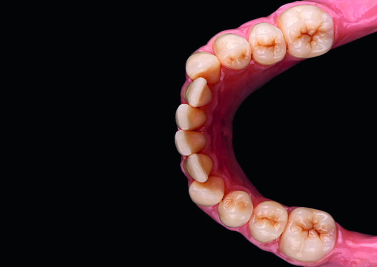 Implantatgestützte OK- und UK-Stegprothesen