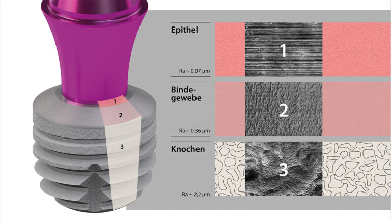 Optimales Einwachsen des Implantats