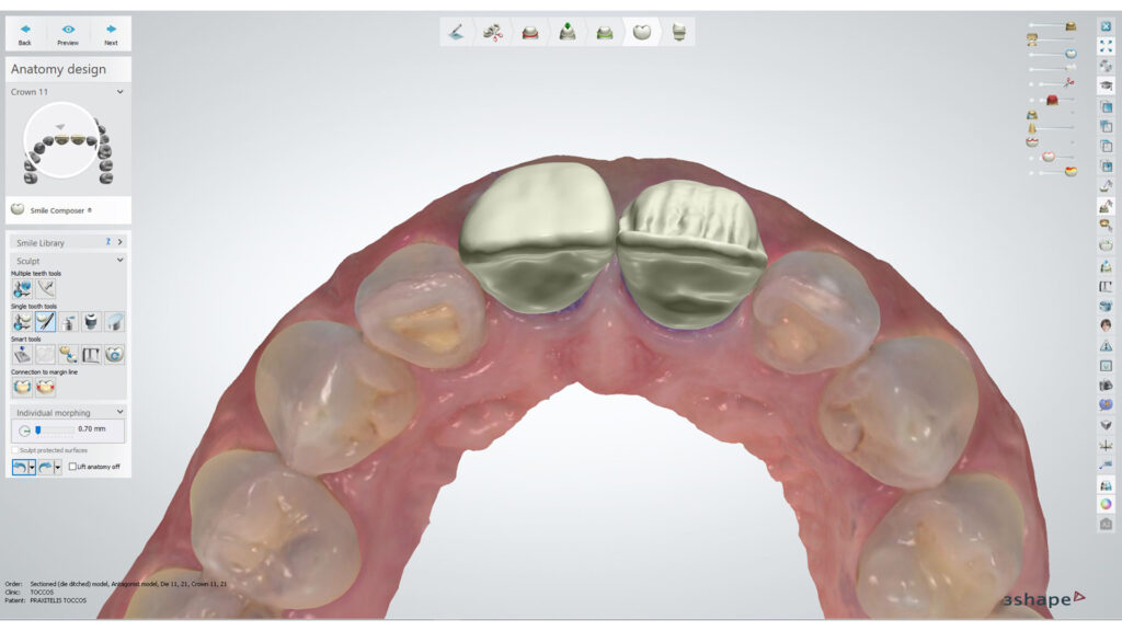 Abb. 10 Gestaltung mithilfe der Canvas-Technik: eine Kombination aus 3D-Bemalung und Schichttechnik. Die ungleichmäßige, dreidimensionale Reduktion schafft unterschiedliche Tiefen und verstärkt die gewünschte Abstufung der Transluzenz in einigen Bereichen der Restauration.