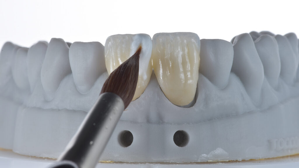 Abb. 16 Die Labialflächen und Linienwinkel sind mit IPS Ceram Power Incisal (Farbe I1) geschichtet worden.