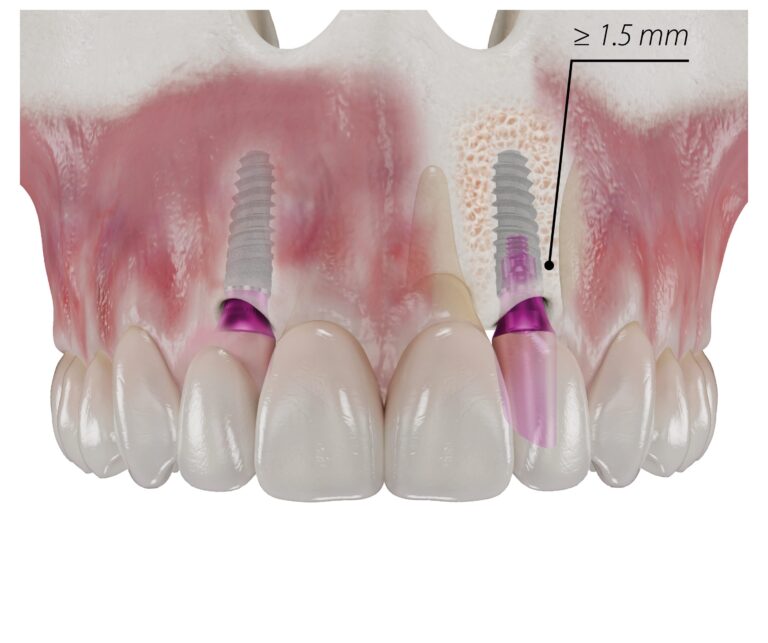Die neueste Erweiterung der copaSKY Produktreihe von bredent medical bietet mit seiner Breite von gerade einmal 3 mm eine Lösung für die Versorgung besonders schmaler Lücken unter 6 mm.